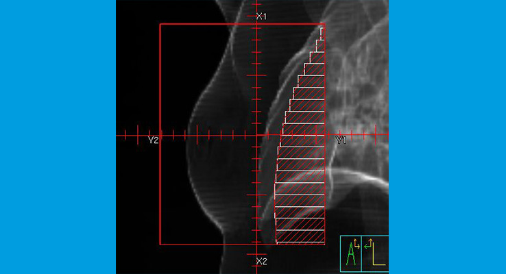 Beispiel für 3D-konformale Bestrahlung_Die Lamellen passen sich dem Tumor in der Brust an, so dass die Lunge geschont wird. Beispiel für 3D-konformale Bestrahlung_Die Lamellen passen sich dem Tumor in der Brust an, so dass die Lunge geschont wird.