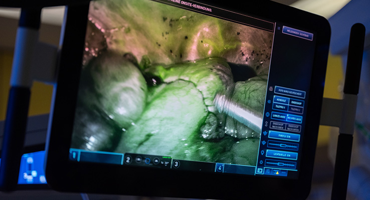3D-Operationsansicht mit ICG-Fluoreszenz während einer robotisch assistierten Operation.