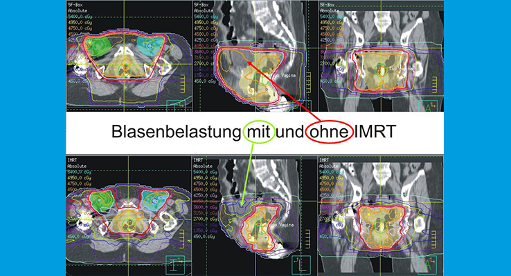 Durch Anwendung der IMRT kann die Blasenbelastung bei der gleichen Patientin immens reduziert werden. Durch Anwendung der IMRT kann die Blasenbelastung bei der gleichen Patientin immens reduziert werden.