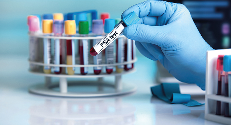 PSA-Test